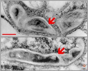  phagocytosed Nocardia (Actinomycetales)in brain abscess